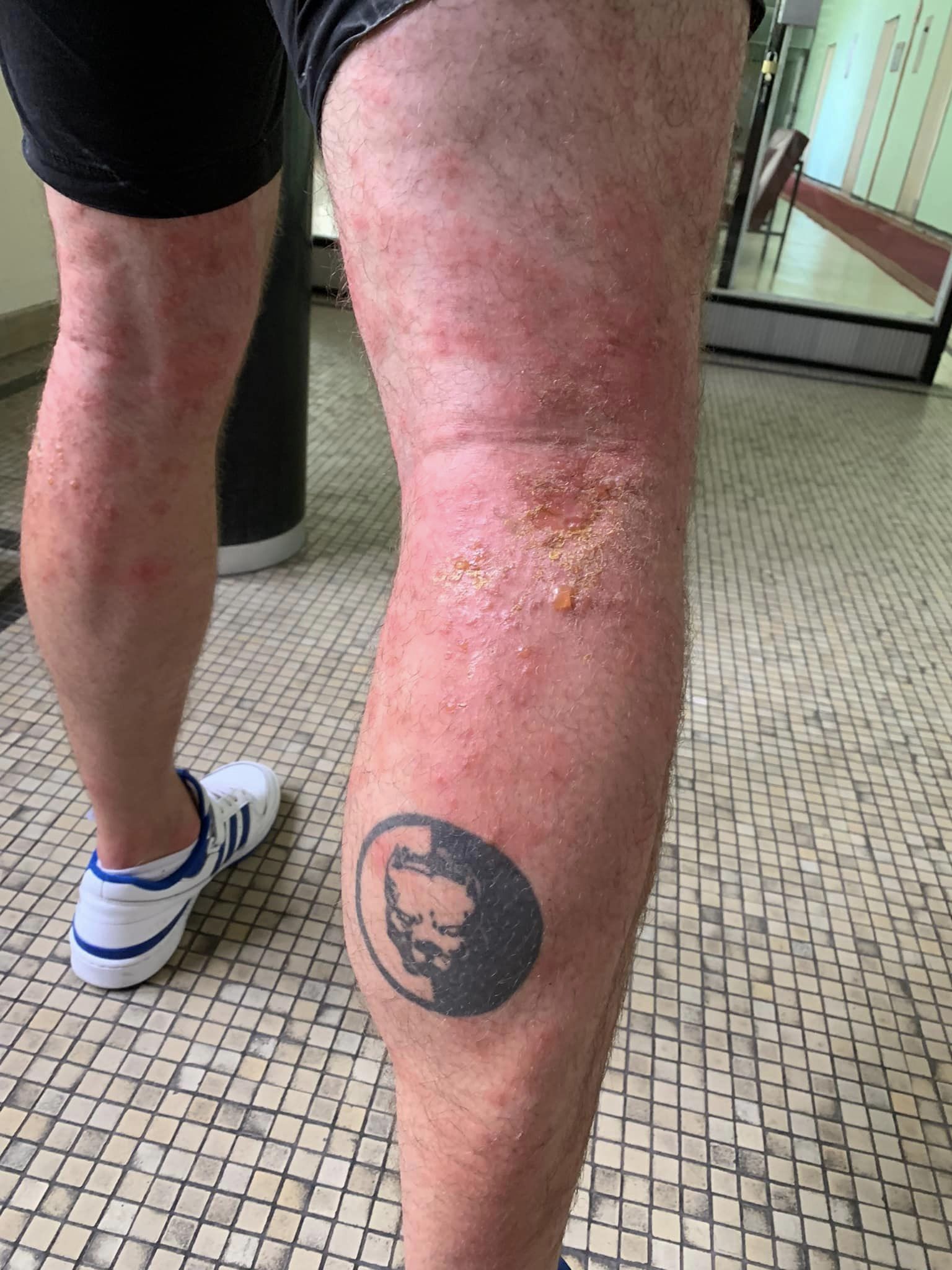 Željko Častvan je danas u teškim inflamacijama po koži od steničara